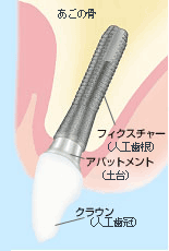 まるで自然の歯のように噛めるインプラント