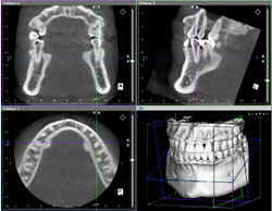 歯科用ＣＴの特徴