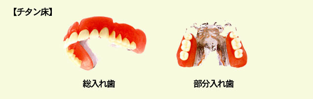 金属床義歯(チタン)