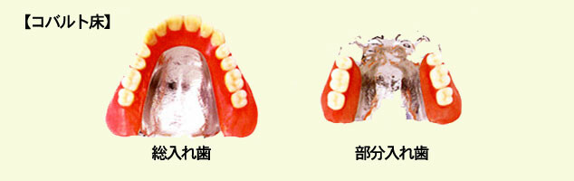 金属床義歯（コバルト）