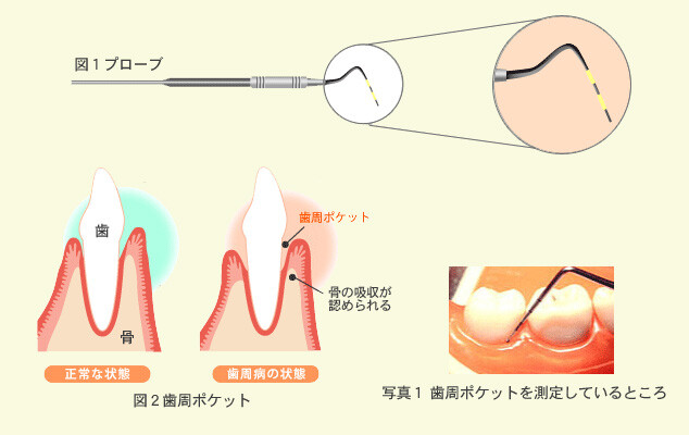 歯周ポケット測定