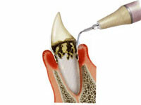 歯石除去（スケーリング）